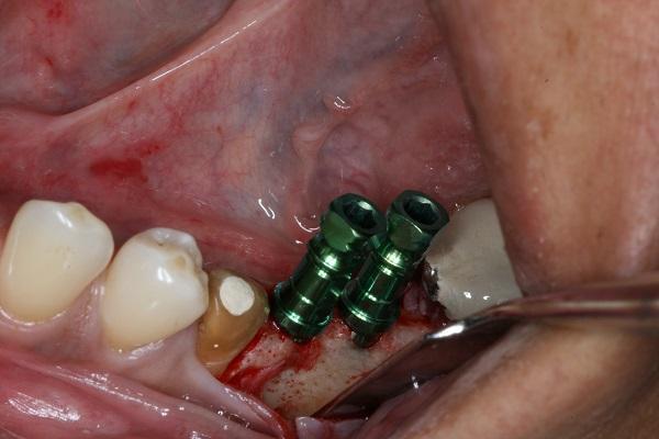 dental implant in midtown nyc
