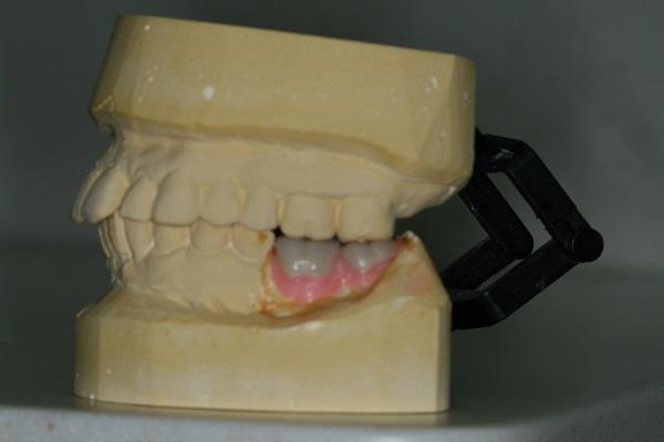creating dental implant in midtown