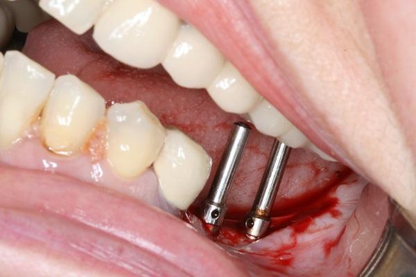 patient before dental implant Manhattan