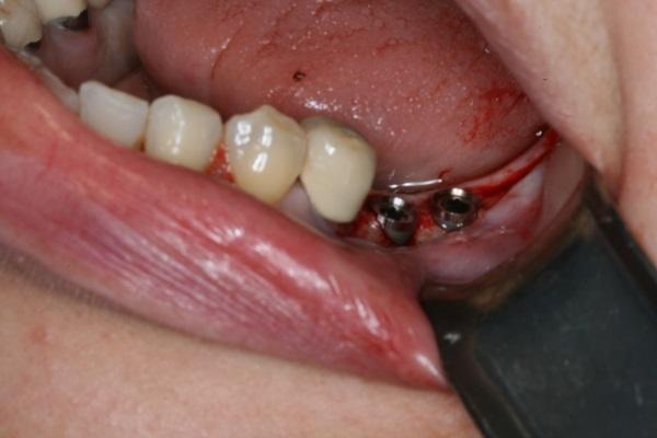 patient before tooth implant in nyc