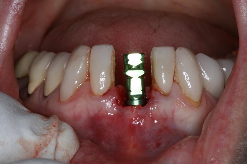 Dental implant | Midtown Dentist