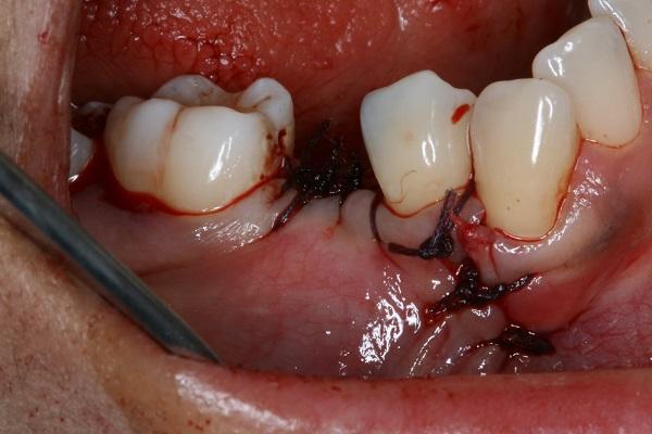 patient with missing tooth in midtown manhattan