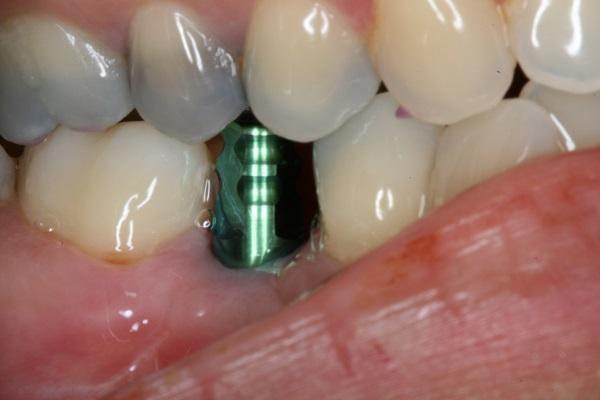 creating a dental implant in midtown nyc
