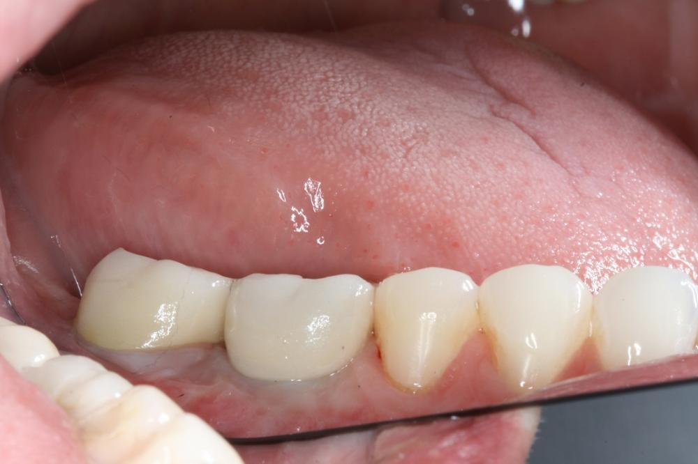 new dental implant in manhattan