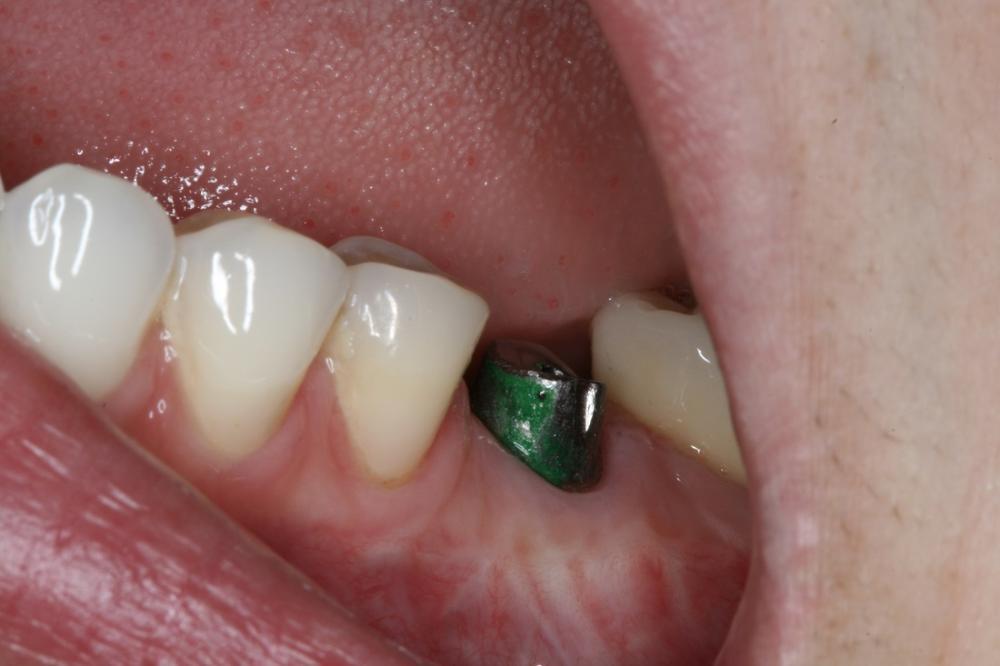 dental implant process midtown manhattan