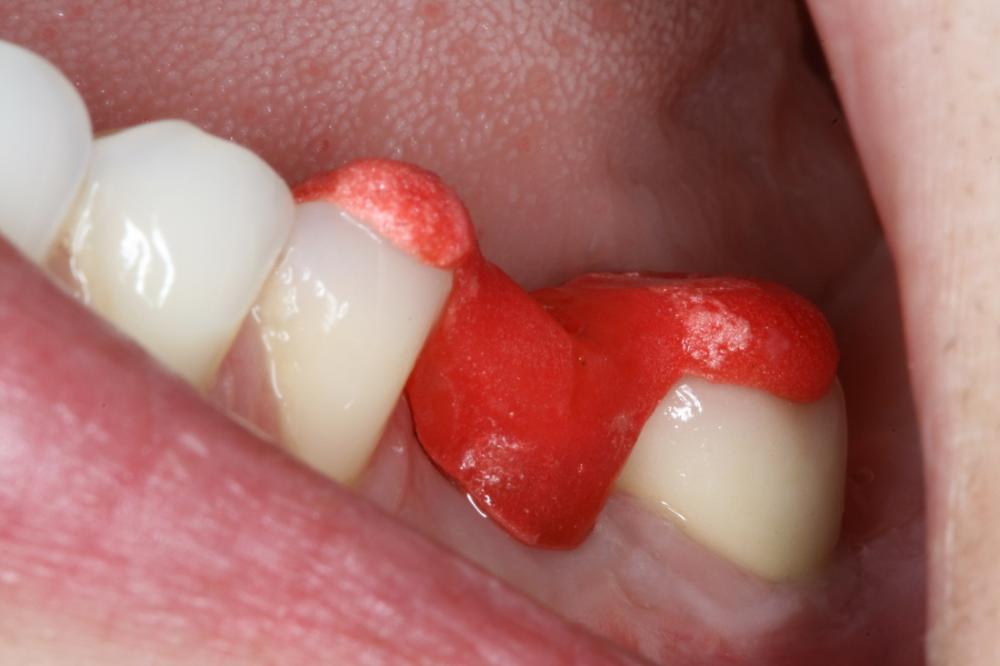 dental implant process nyc