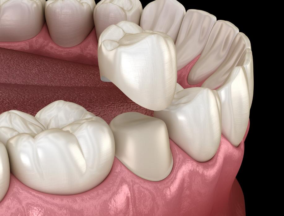 dental crowns