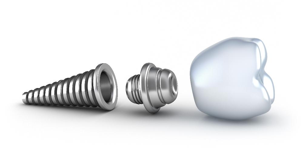 dental implant
