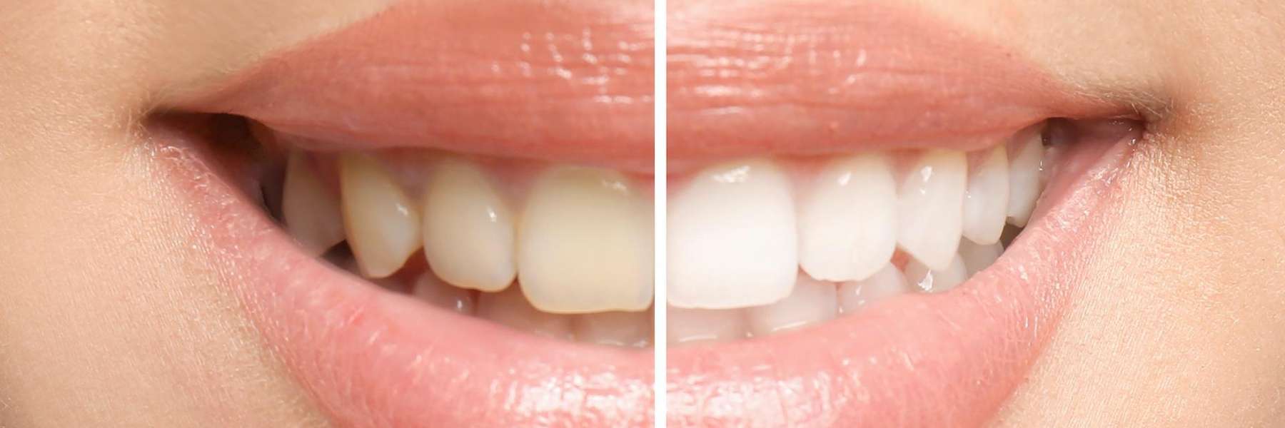 before and after teeth whitening