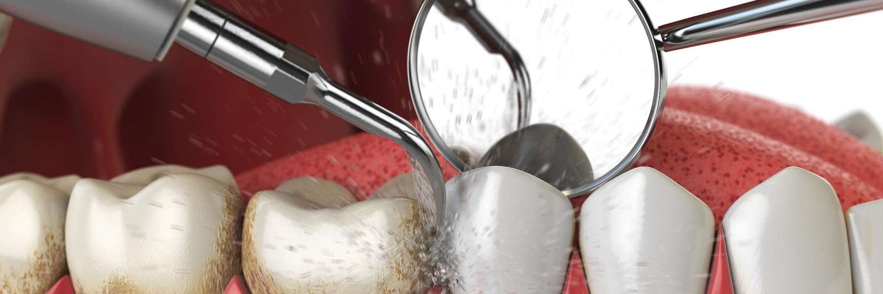dental cleaning