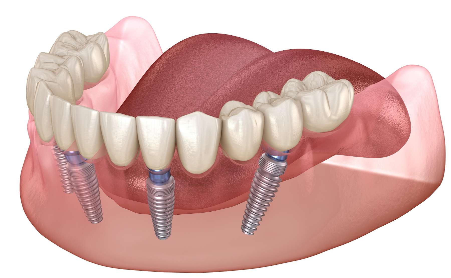 Dental Implants Diagram | Midtown Dental Implants