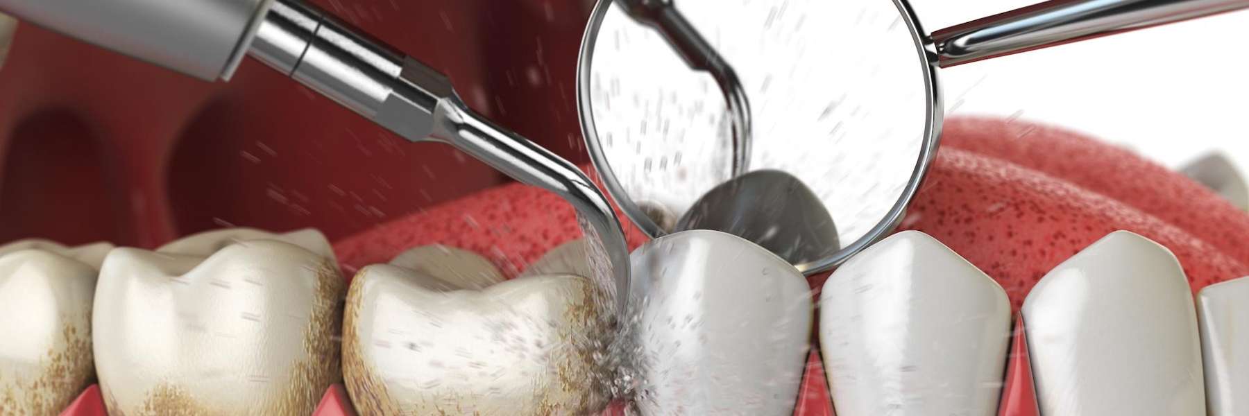 dental tools being used to clean gums