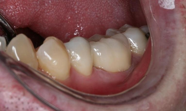 Patient with new dental implant in midtown nyc