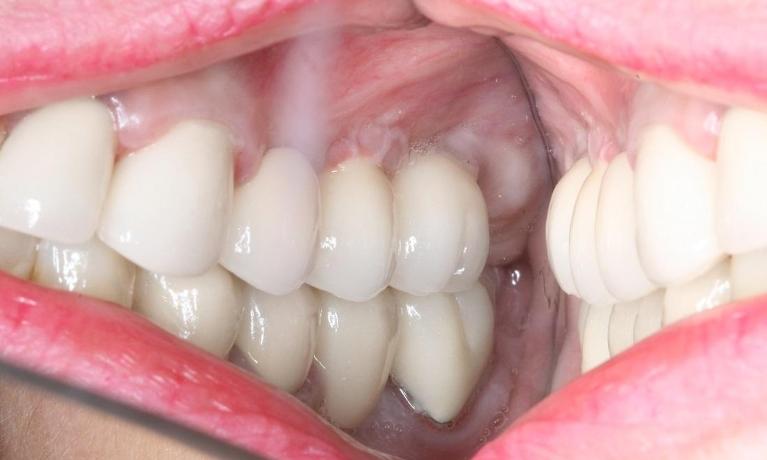 patient with new dental implant in manhattan nyc