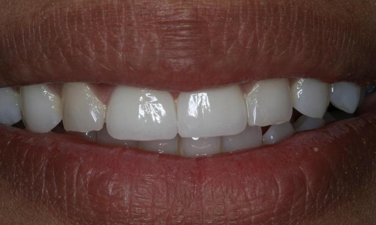 patient with new dental implant and crown in midtown nyc