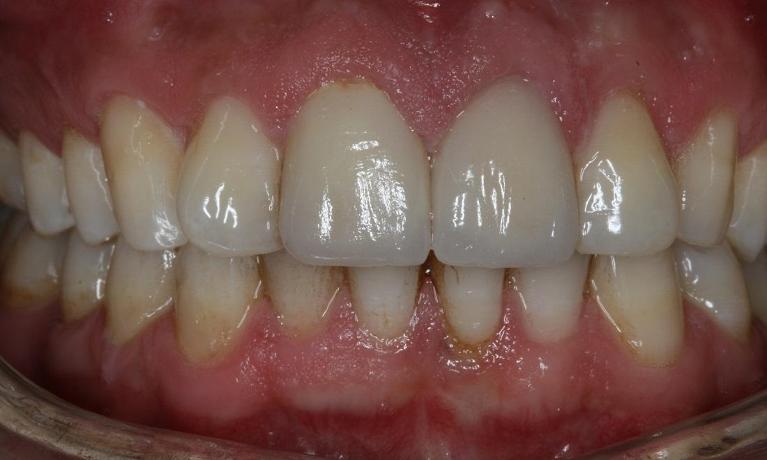 patient with new dental implant in midtown nyc