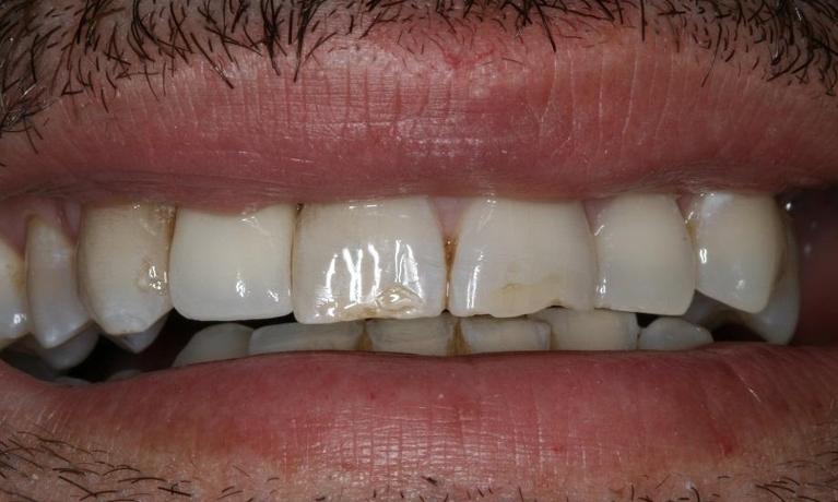 patient with new front dental implant in nyc