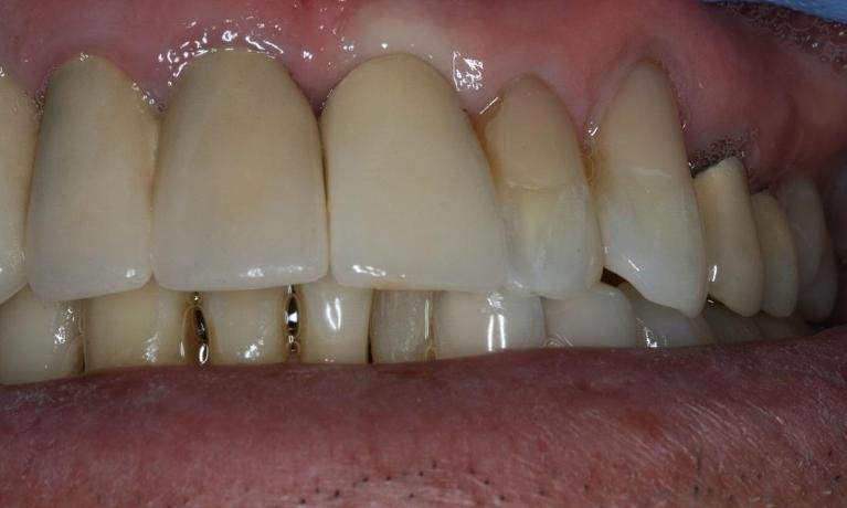 Front-Tooth-Implant-After-Image