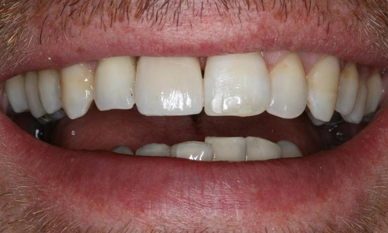 Implant-Crown-After-Image