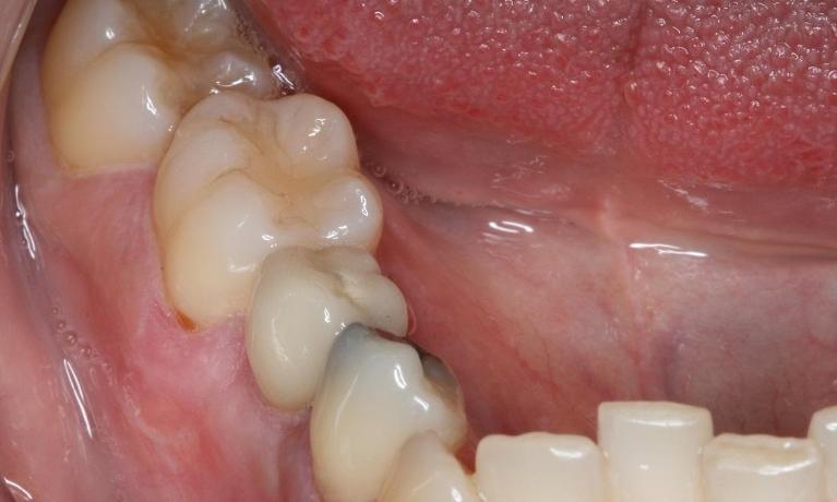 dental implant after photo midtown nyc