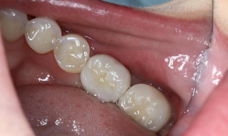 patient with new dental implant nyc