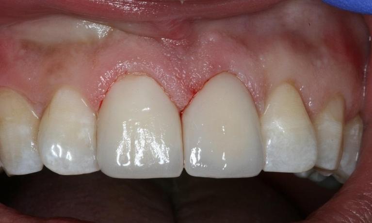 Porcelain-Crowns-After-Image