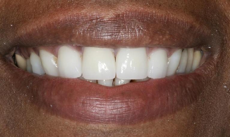 patient with new porcelain veneers in midtown nyc