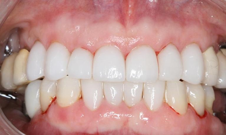 Porcelain-Veneers-After-Image