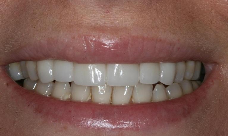 Porcelain-Veneers-After-Image