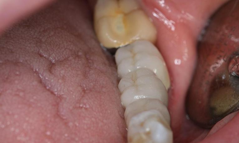 patient with new crowns on implants in nyc