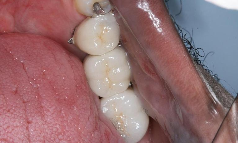 patient with new dental crown and implant in midtown new york