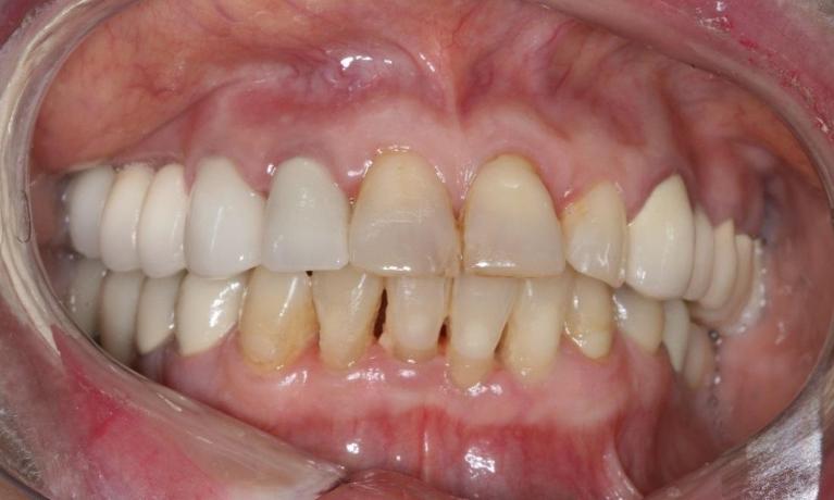 Patient with new dental implants in midtown nyc