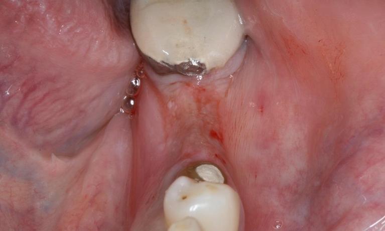 patient before dental implant | Midtown Dentist