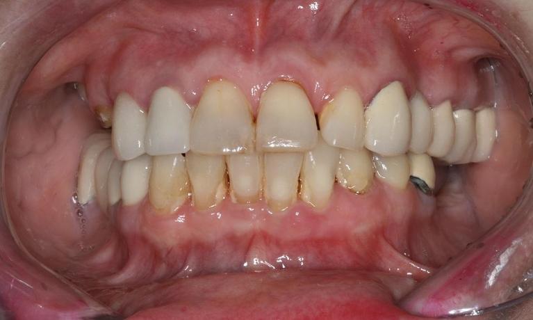 patient before implant restoration in manhattan