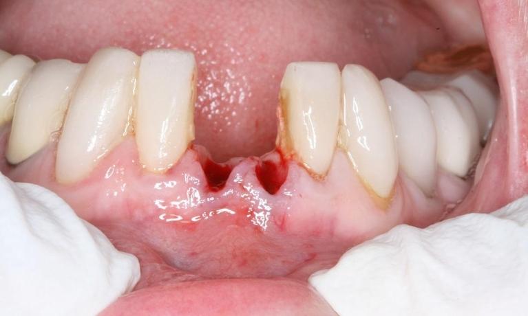 Implant-Restorations-of-Front-Teeth-Before-Image
