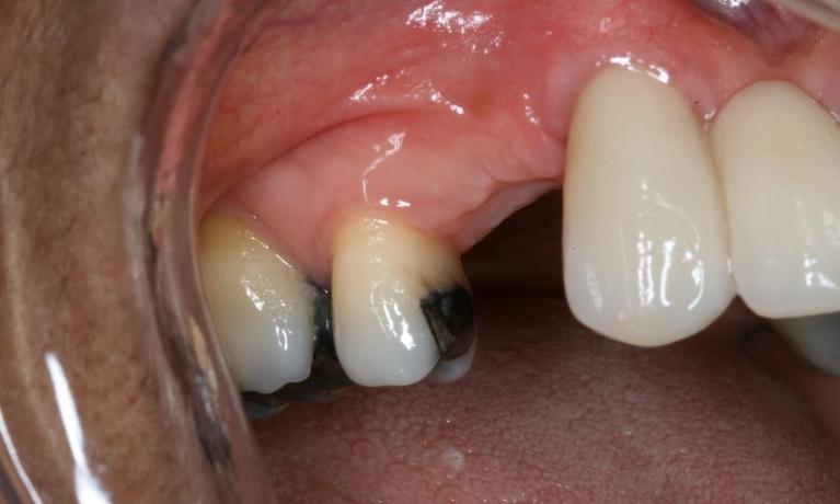 patient with missing tooth in midtown nyc