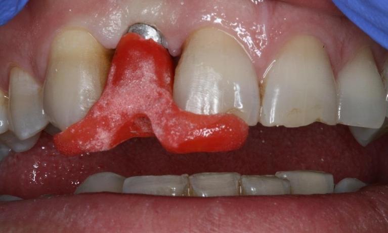 Client getting new dental implant in midtown nyc