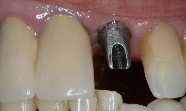 Front-Tooth-Implant-Before-Image