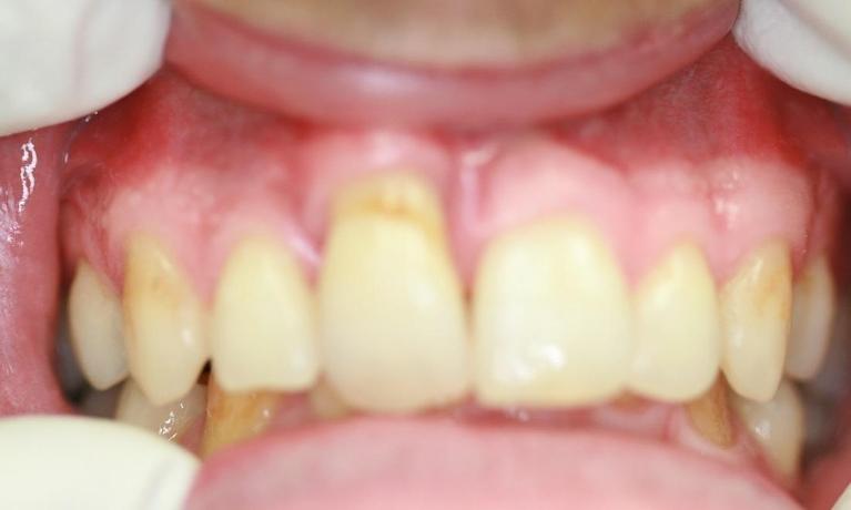 Implant-Crown-Before-Image