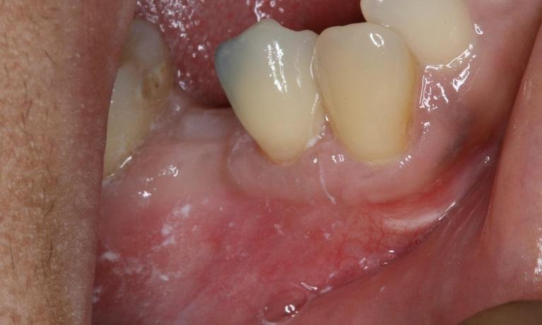 dental implant before photo in midtown nyc