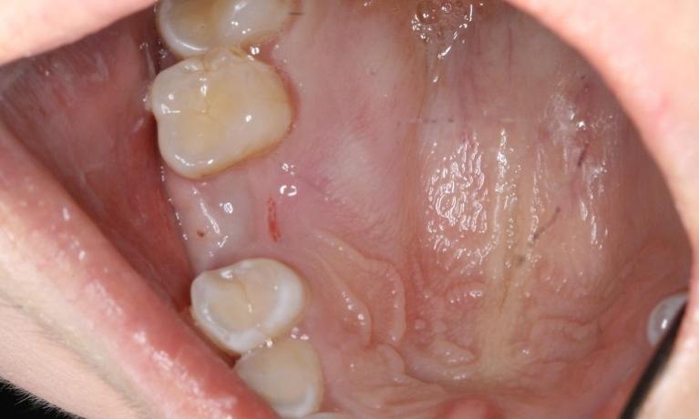 patient before dental implant in nyc