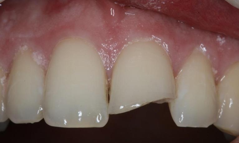 Porcelain-Crowns-Before-Image