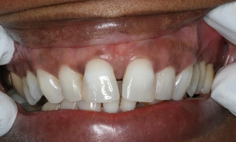patient with large gap in tooth in midtown nyc