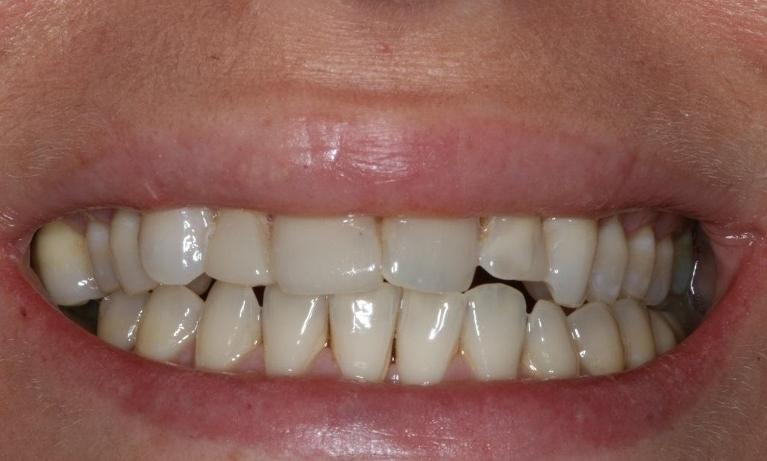 Porcelain-Veneers-Before-Image