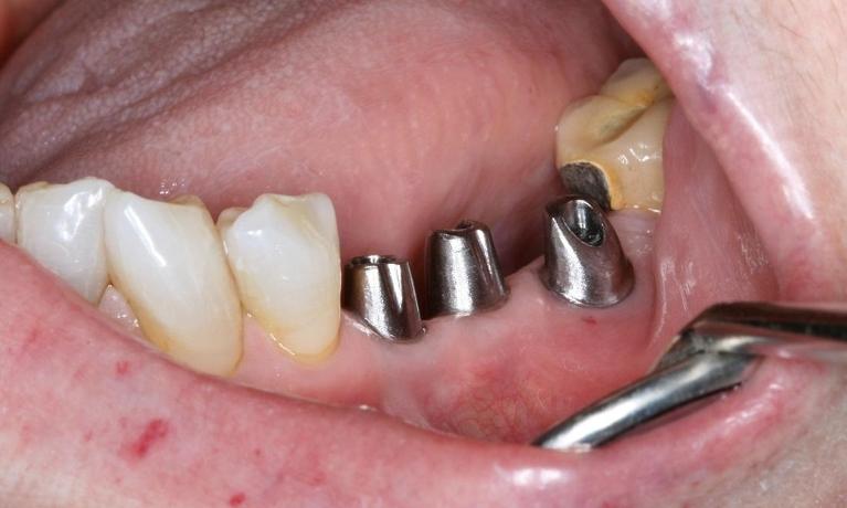 patient with dental implants placed in midtown nyc