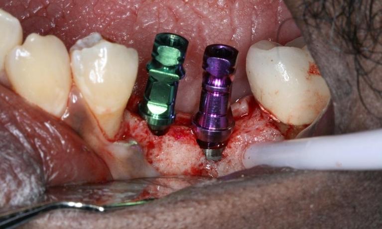 patient with dental implants in midtown new york