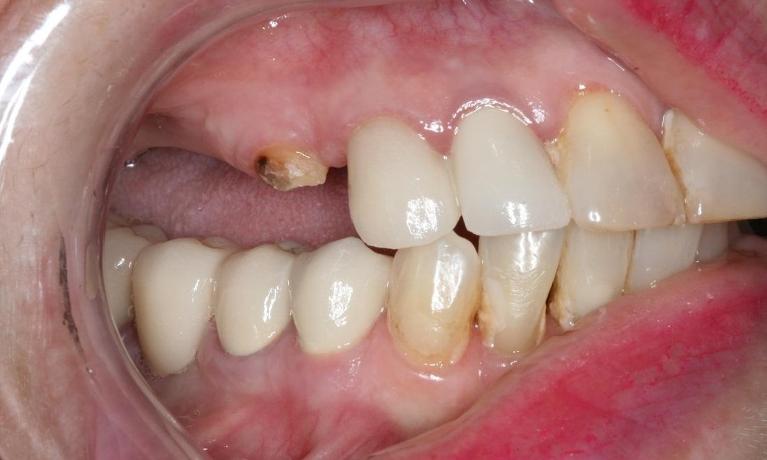 patient in need of dental implants on molars