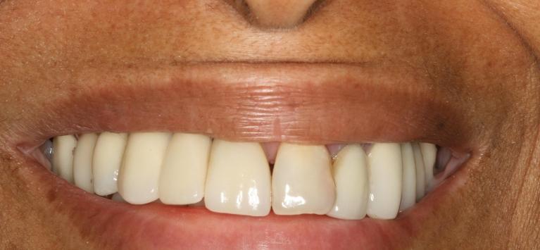 Implant-Case-After-Image