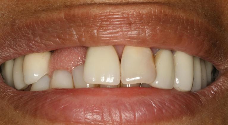 Implant-Case-Before-Image